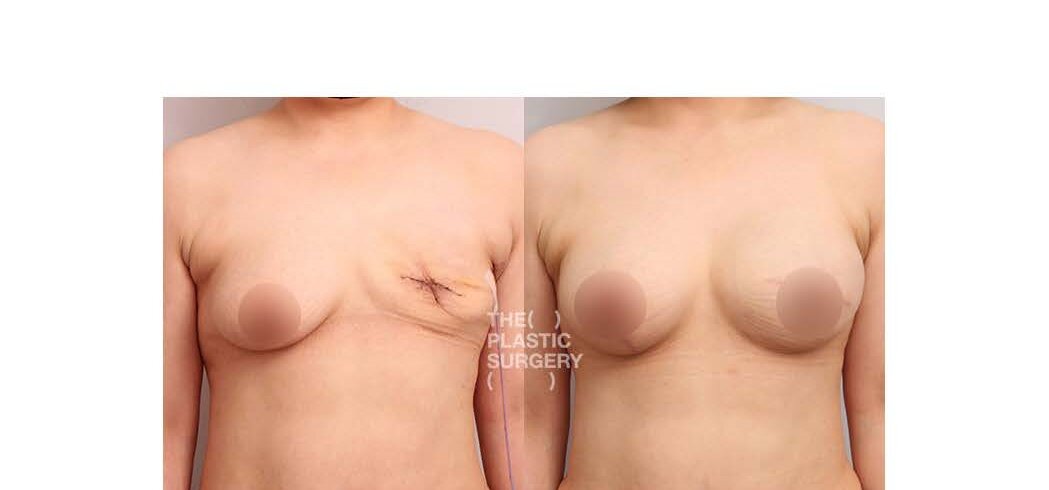 Brustimplantat-Entfernung